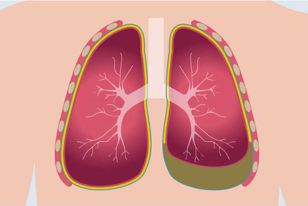 Ung thư màng phổi là tình trạng tế bào ung thư phát triển ở lớp màng bao quanh phổi